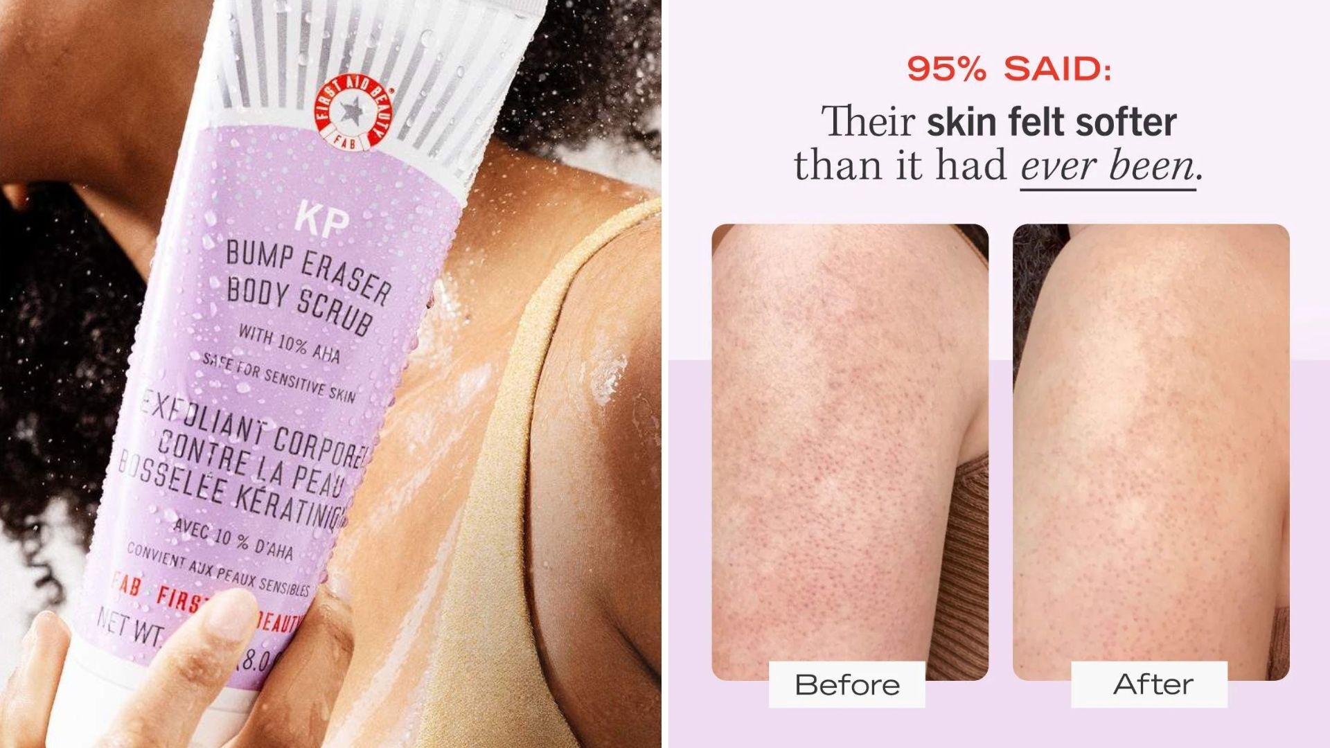 How to Get Rid of Strawberry Legs in Time for Summer
