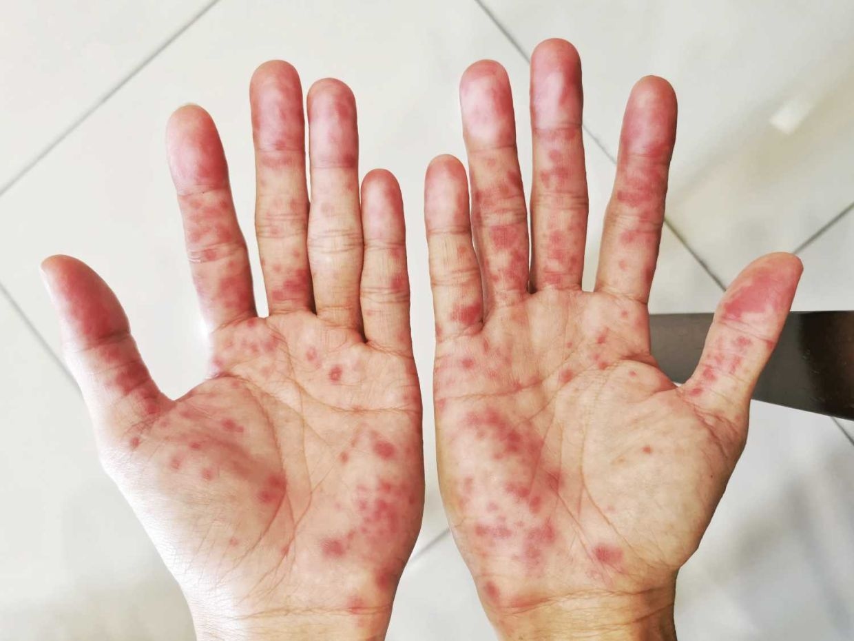 Johor sees drop in dengue cases, rise in HFMD