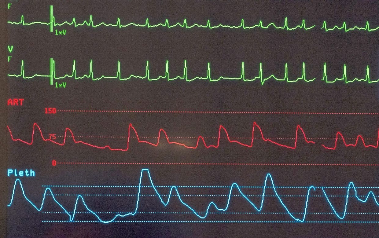 Atrial fibrillation: Treating a fluttering heart