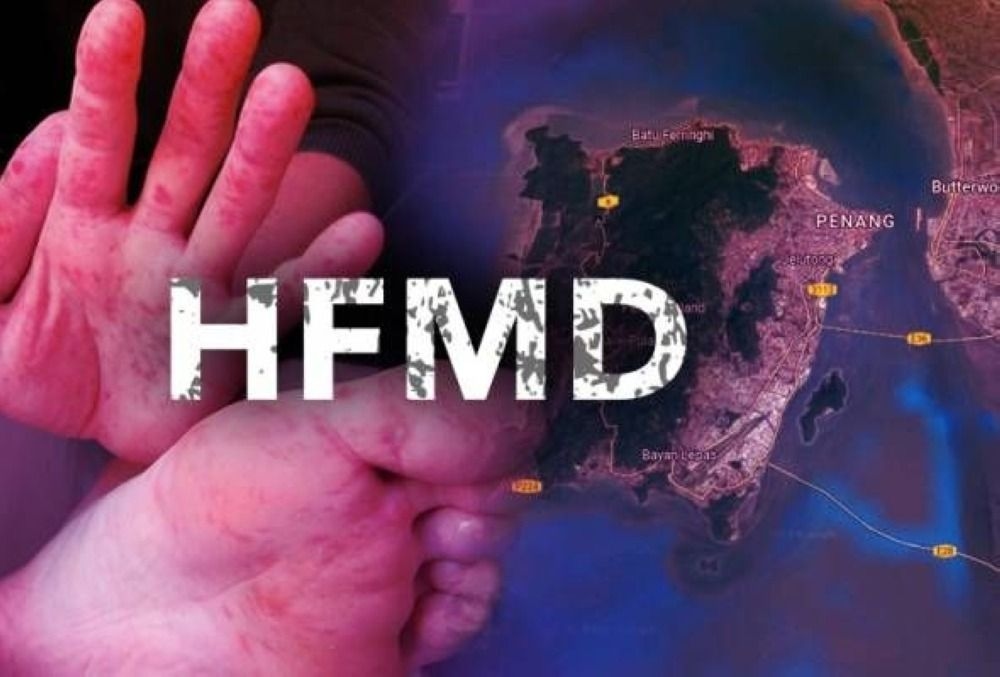 Kelantan records over 11,800 HFMD cases so far this year