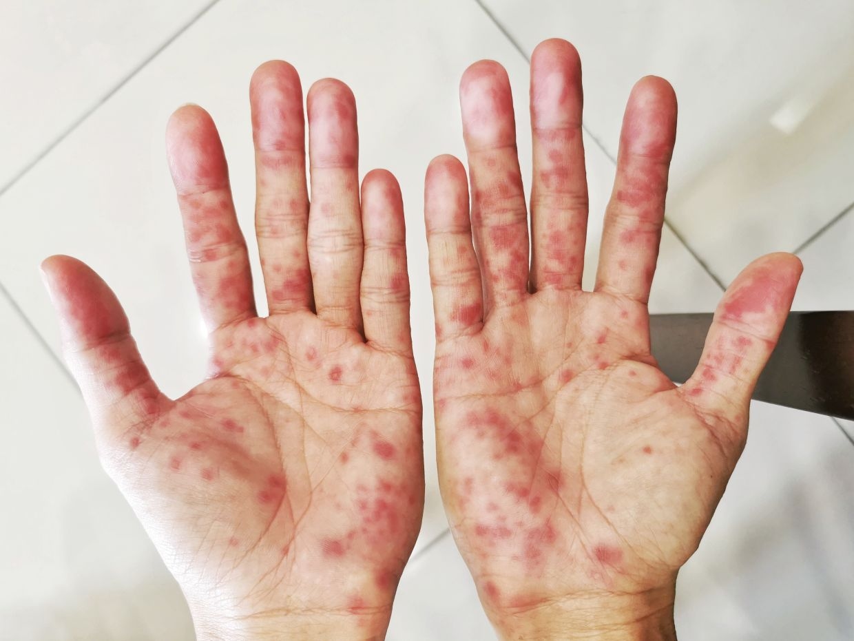 Thailand warns of hand, foot and mouth disease outbreak