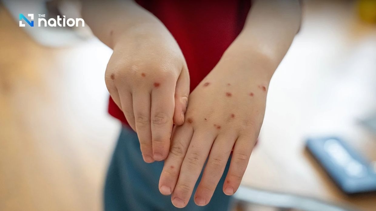 Thailand reports 40 monkeypox cases in 2025, urges high-risk groups to practise safe sex