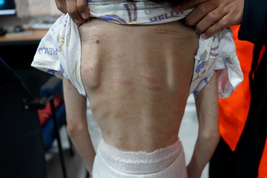 Girl, 11, beaten and scalded, parents in custody