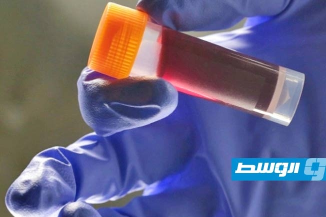 دراسة تكشف فصيلة الدم الأكثر عرضة للإصابة بالسكتة الدماغية المبكرة
