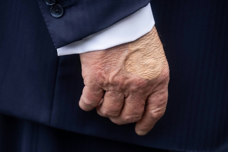 'Benign' vein issue behind Trump's swollen legs: White House