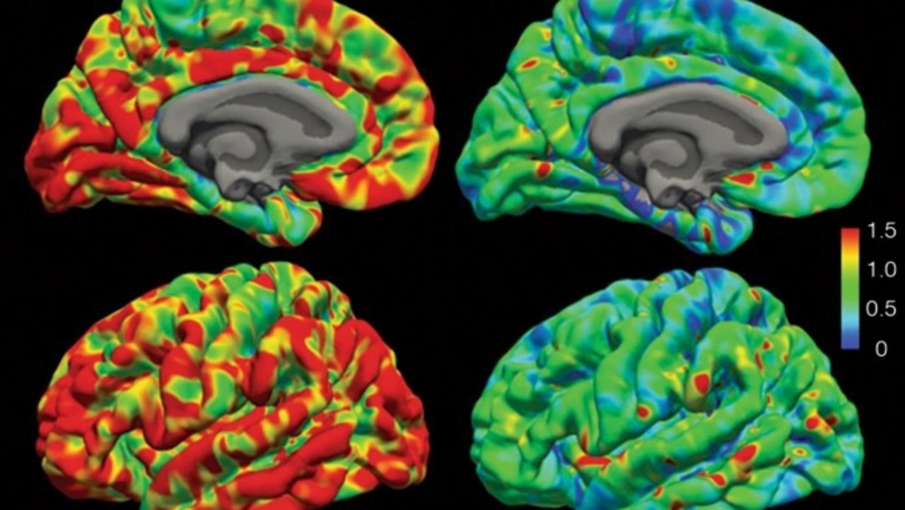 Green light for psychedelic drugs trial to treat binge-eating