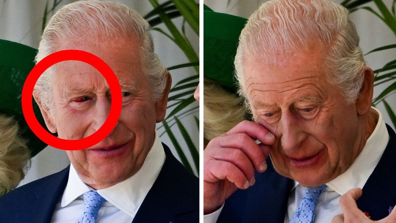 King Charles unveils painful-looking injury while hosting French president Emmanuel Macron
