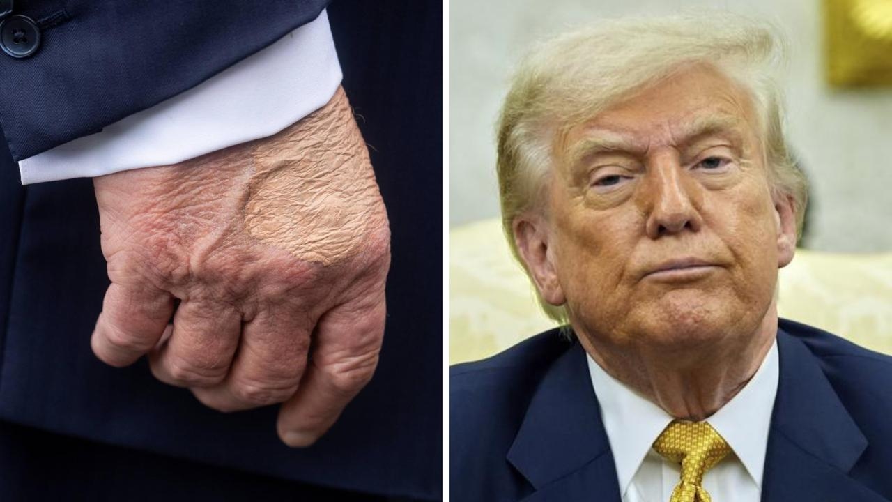 US politics live: Concerning photo shows Donald Trump's ‘chronic' condition