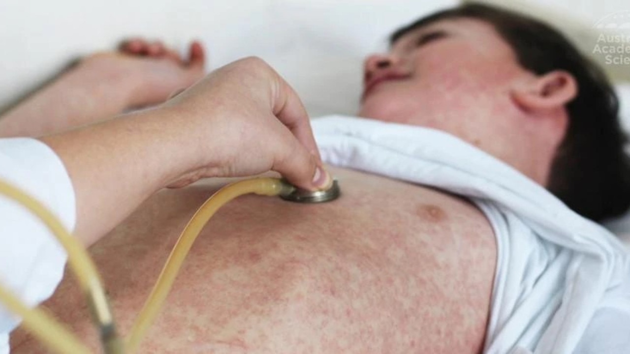 NT Health issues measles alert as confirmed case travels through Darwin, Alice Springs