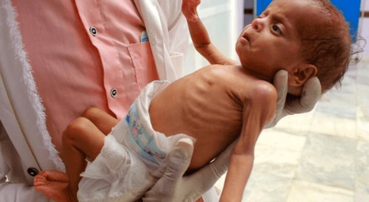 66 Children Dead from Starvation in Gaza