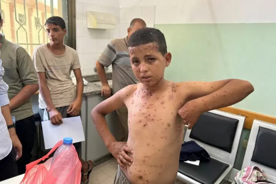 Wounds of War: Gaza's Children Battle Skin Diseases Without Medicine