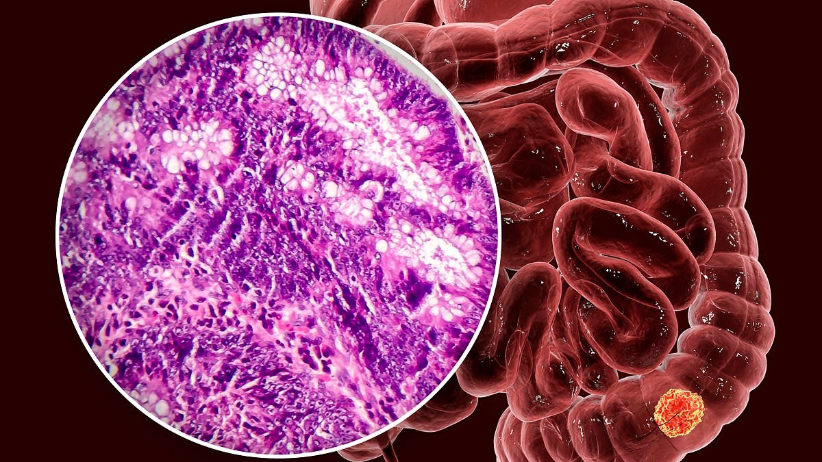 Huge cancer risk linked to bad habit that thousands of Australians are doing daily