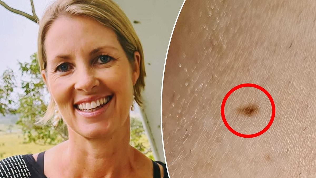 The doctor told me the unusual freckle on my back was 'nothing to worry about'. He was wrong... and the news only got worse from there