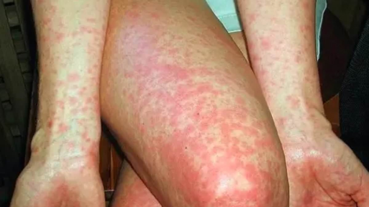 Aussie state on edge as sixth case of deadly disease emerges this year