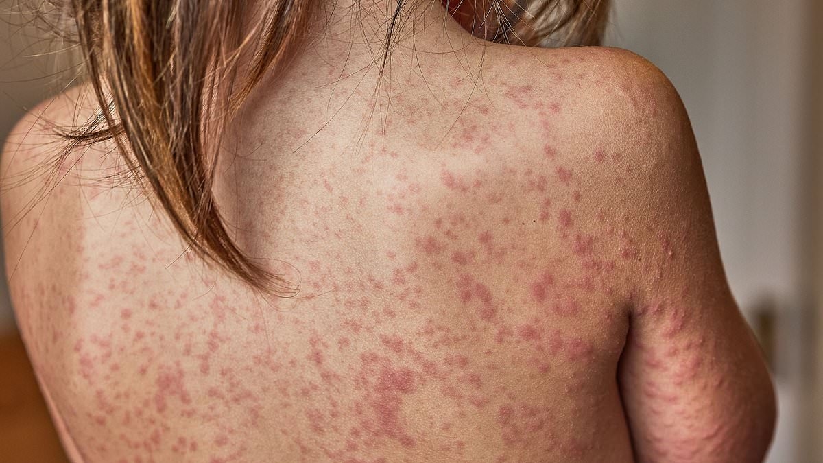 Urgent health warning issued for Sydney after person with measles returns from Vietnam
