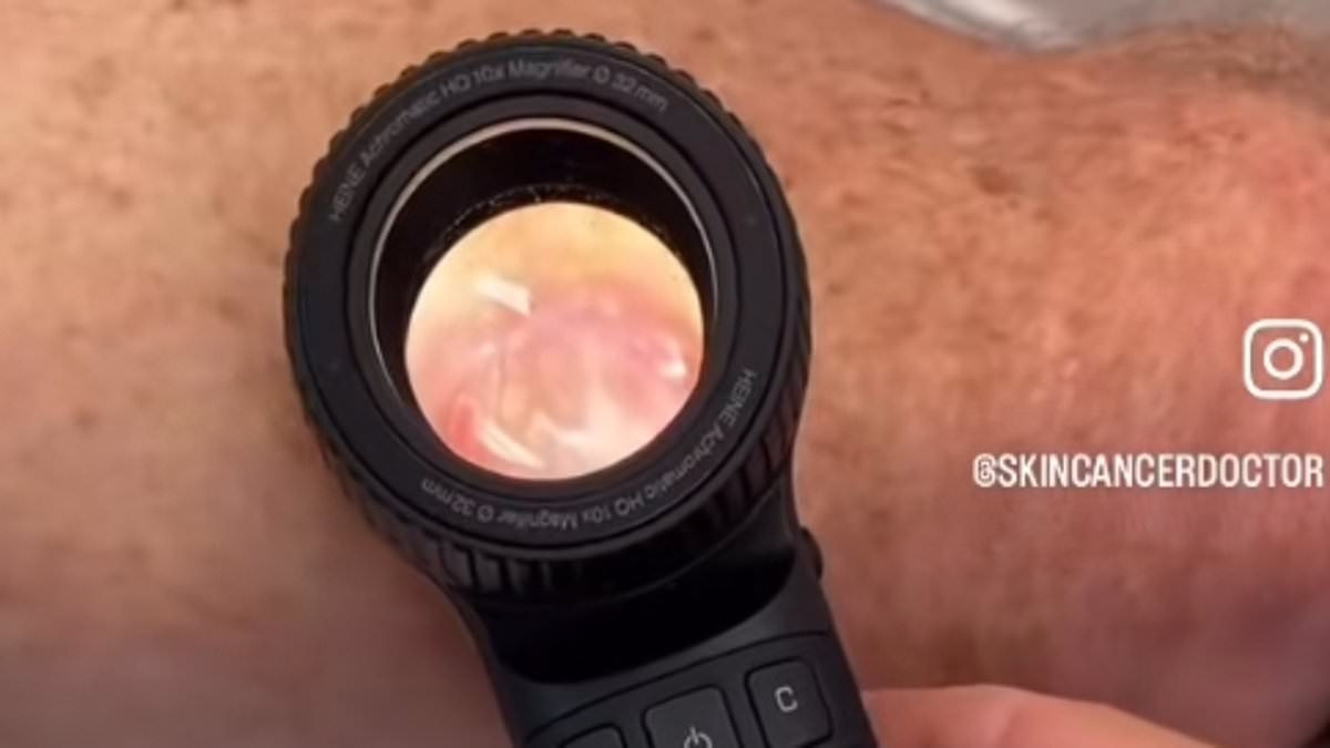 Skin cancer doctor shares shocking video of 'worst melanoma' he's ever seen: 'They don't always look like moles'