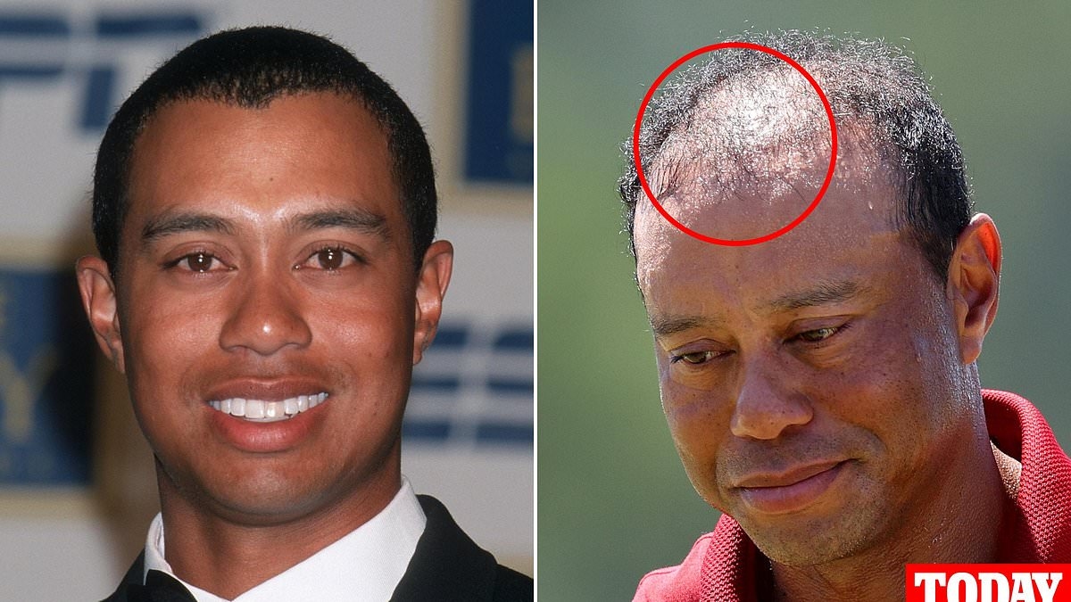 EXCLUSIVE Plastic surgeon reveals the rumored surgery Tiger Woods had that has failed TWICE
