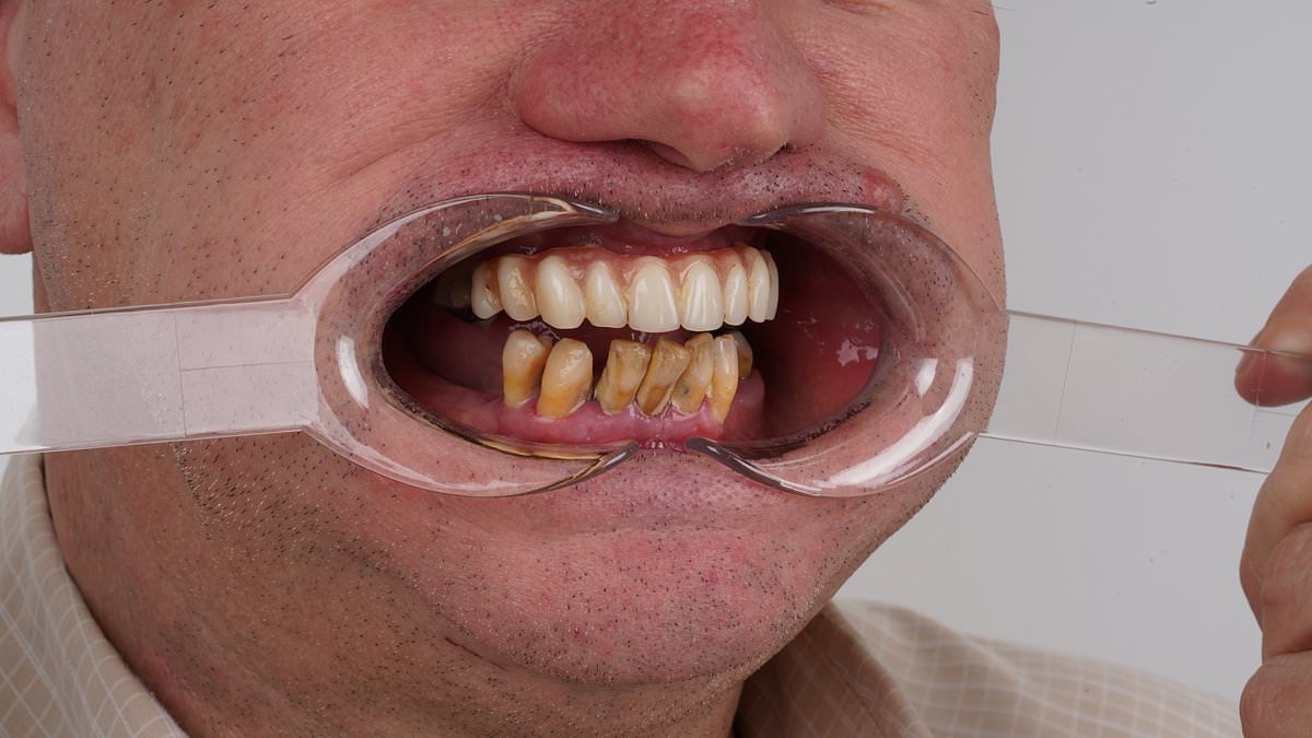EXCLUSIVE 'I sawed out my rotting teeth with a shoelace-I thought it would be like shelling peas but I was very wrong'