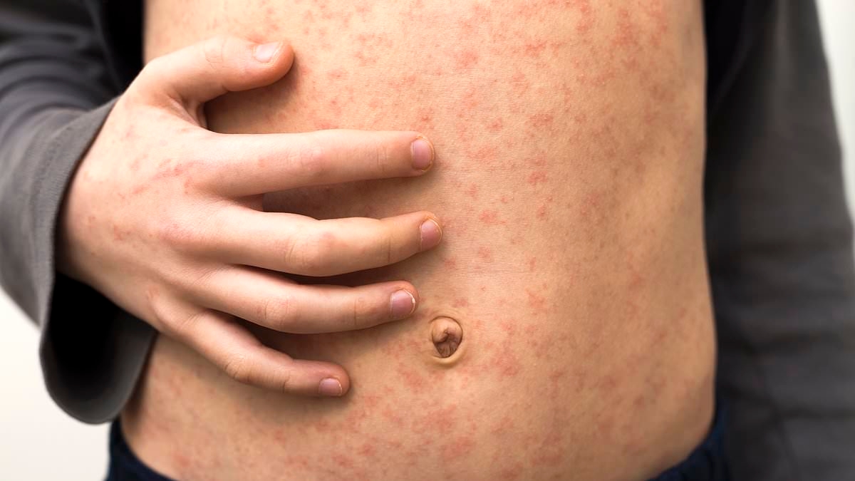 I have seen the dreadful impact of measles first-hand. Forget the conspiracies, by refusing to vaccinate your children against this killer you are abusing them: DR MARTIN SCURR