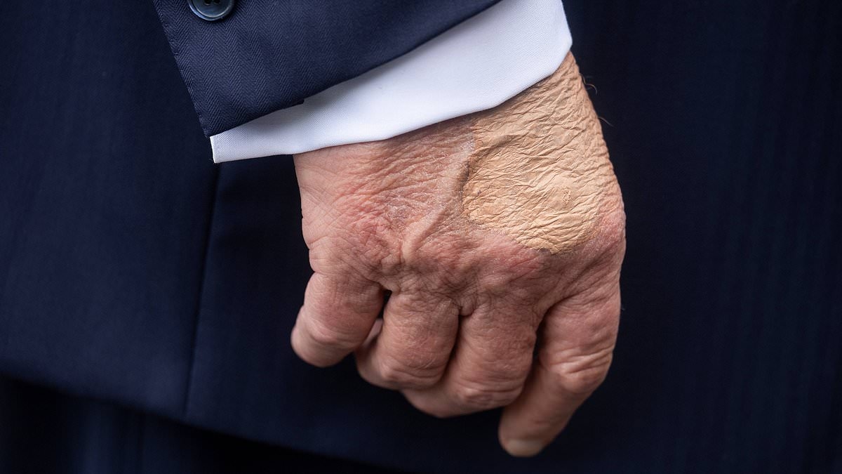 BREAKING NEWS White House reveals cause of Trump's 'swelling' on hands and legs amid growing concerns