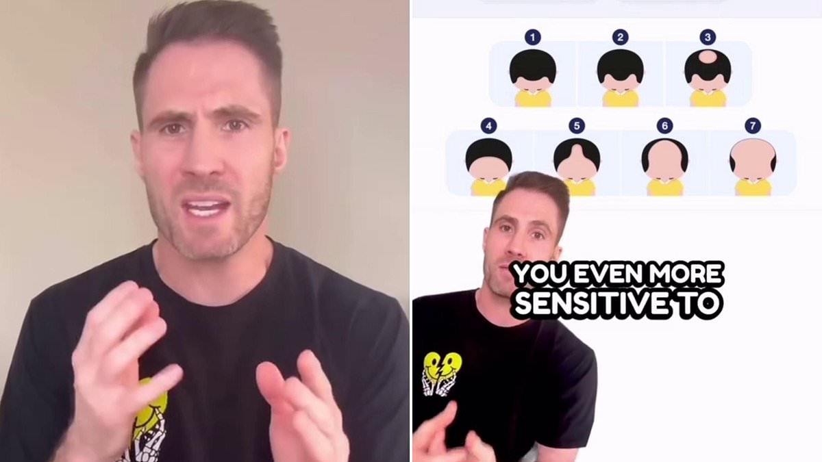 Doctor reveals the simple clue on your hand could predict whether you'll go bald