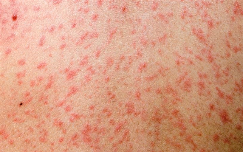 Measles claims territory in District East