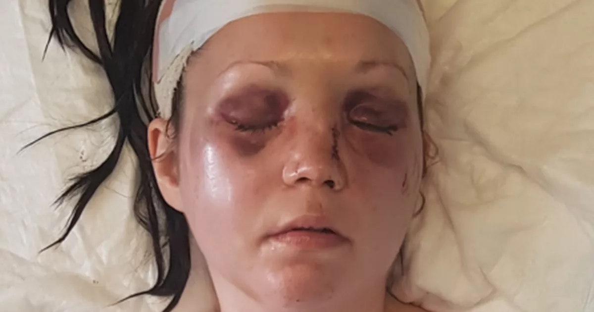 Scots mum had broken face 'pieced back together' after horror horse riding accident