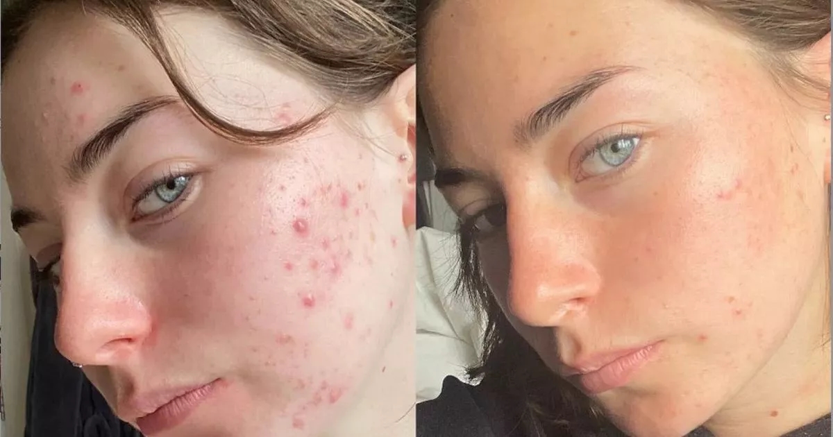 Non-greasy SPF that's 'anti-blemish' gives clearer skin and 'more confidence'