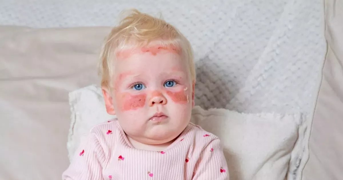 Scots baby left with 'severe burns' despite wearing factor 50 sun cream amid heatwave
