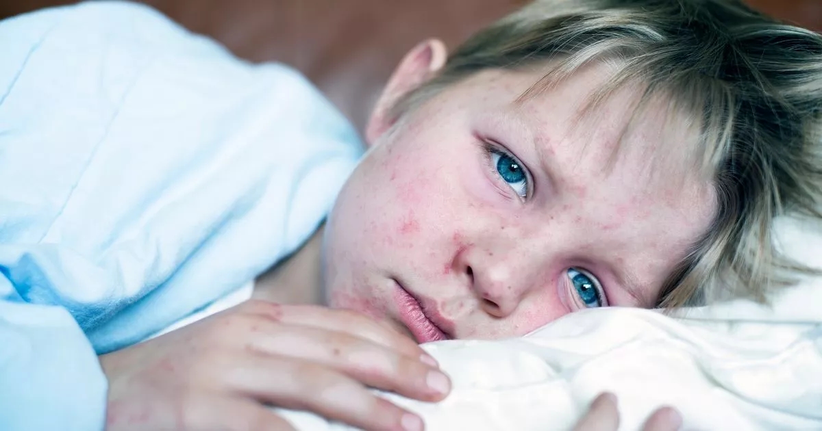 Parents issued urgent measles warning after child dies from 'eliminated' disease
