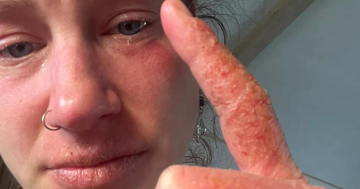 'I had small rash - now I look like I've been burnt after reaction'