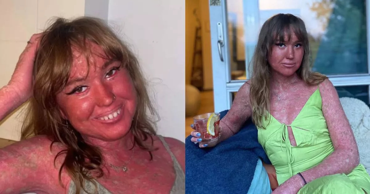 'My scaly skin is constantly peeling and growing, I've been called a monster but I feel unique'