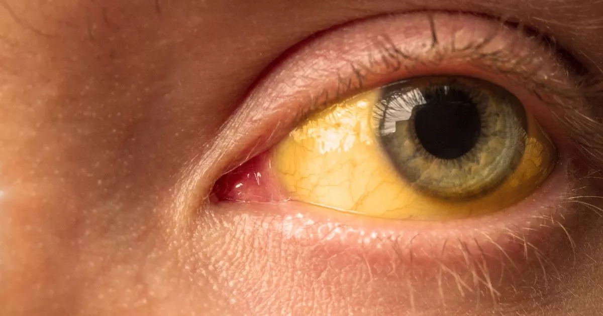 Misunderstood illness leads to dark urine as doctor shares red flags