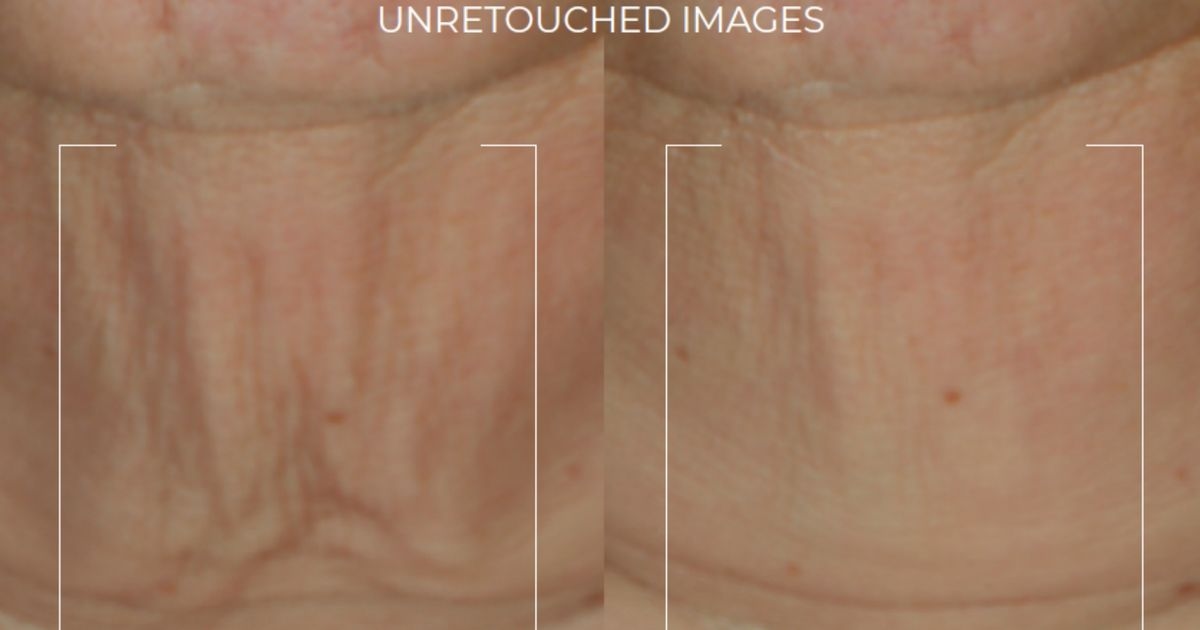 ‘Non-invasive neck lift in a stick' that shoppers call a ‘magic eraser for wrinkles'