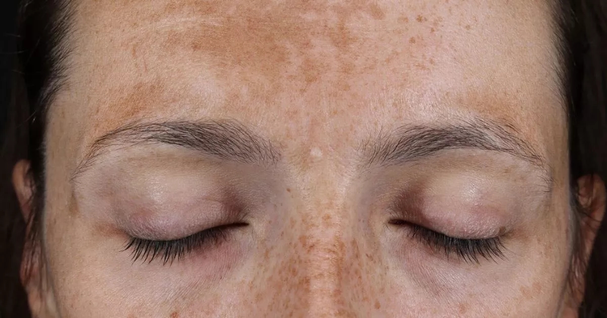 Results from this new pigmentation serum are incredible – skin is transformed in weeks
