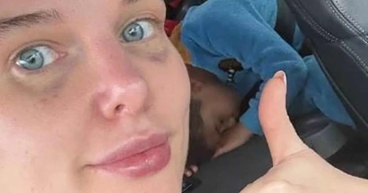 Coronation Street's Helen Flanagan shows off painful 'black eye' after surgery