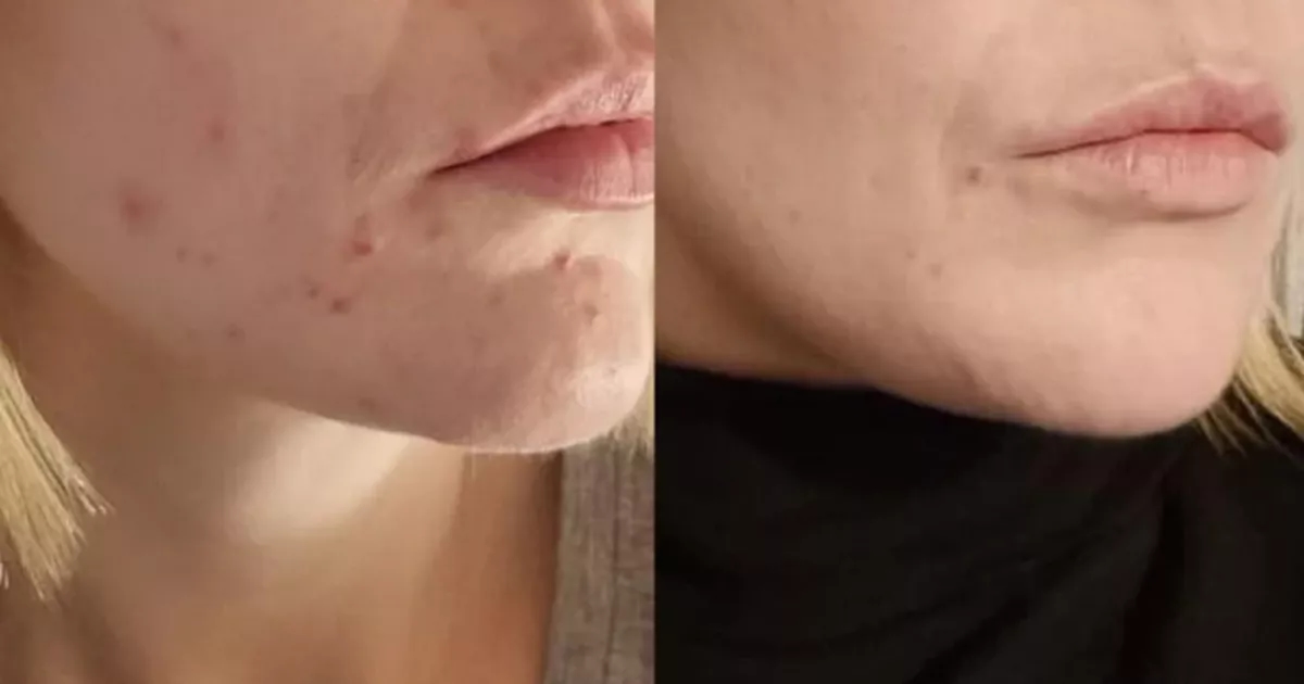 Skincare fans praise 'gentle' face gel that targets blemishes 'overnight'