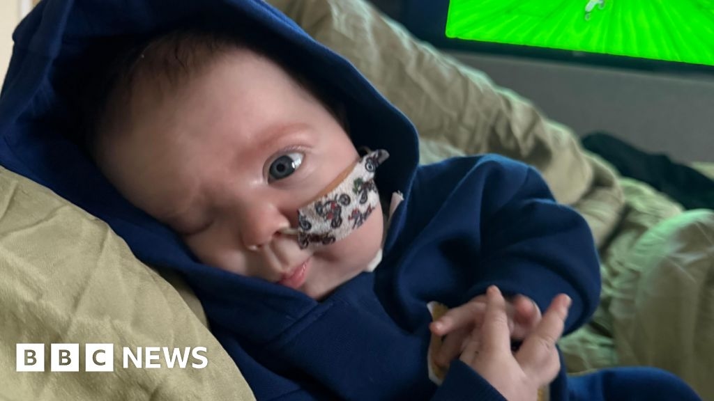 Goldenhar Syndrome: 'Perfect' baby born with extremely rare condition