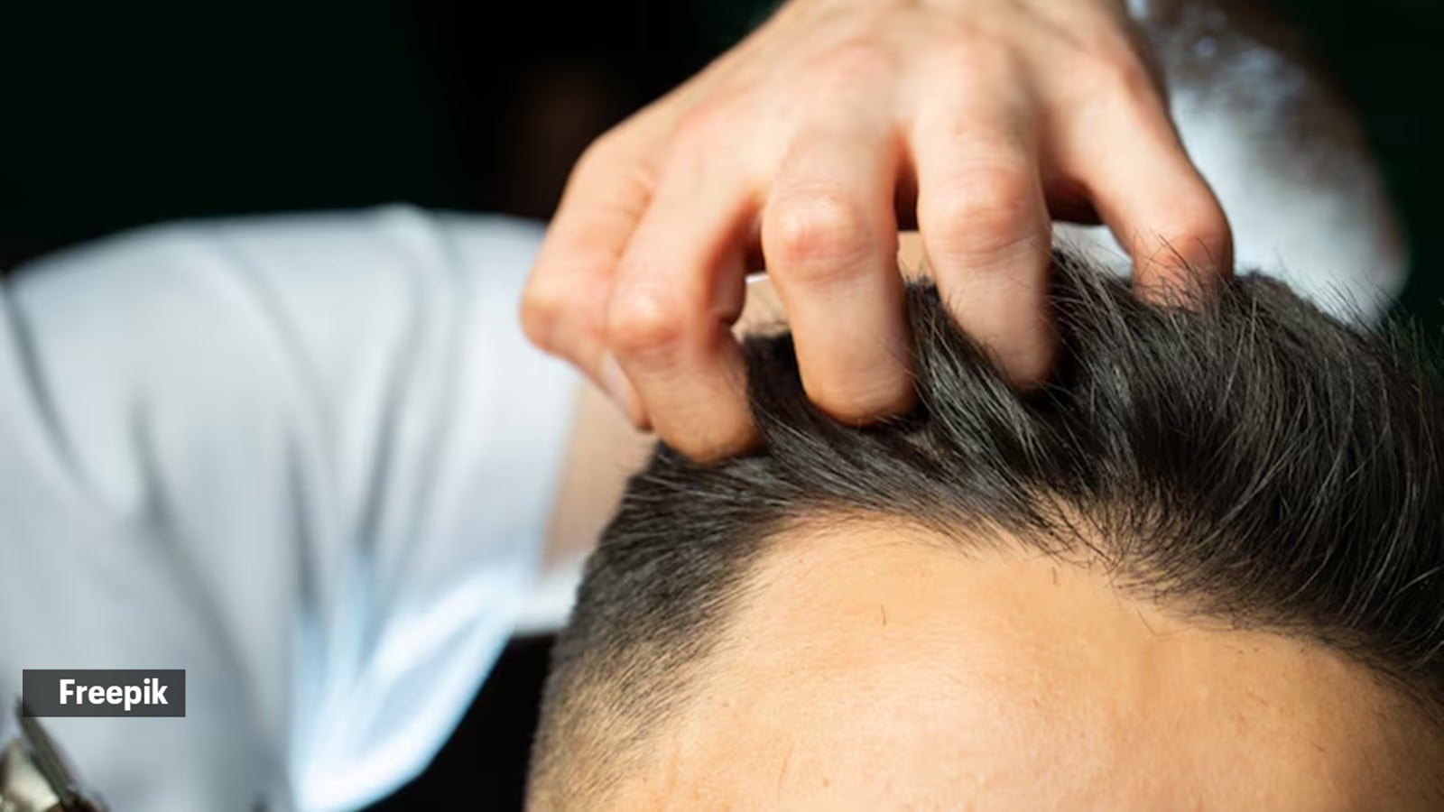 As ‘Turkish Hairlines' meme goes viral, here's a closer look at India's troubled hair transplant industry