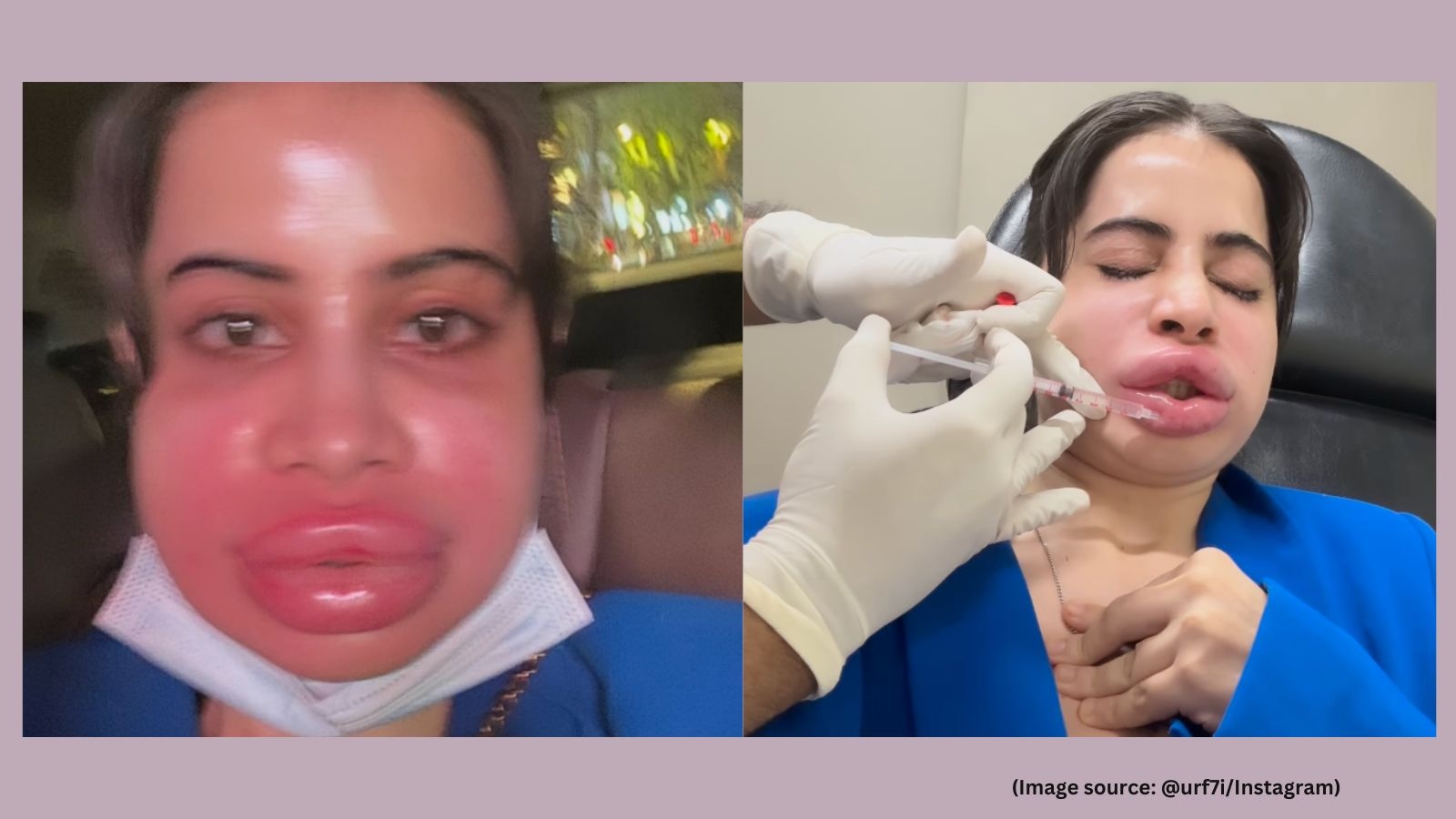 Uorfi Javed gets her lip fillers dissolved, shares unrecognisable video of swollen face