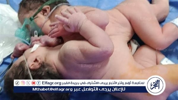 ولادة نادرة لتوأم ملتصق بمستشفى الفيوم العام