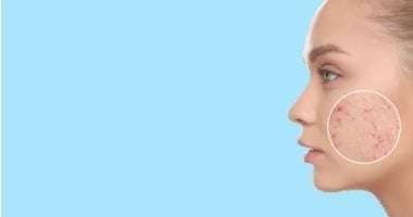 أسباب ظهور حب الشباب فى الرقبة.. كيف تتخلص منه