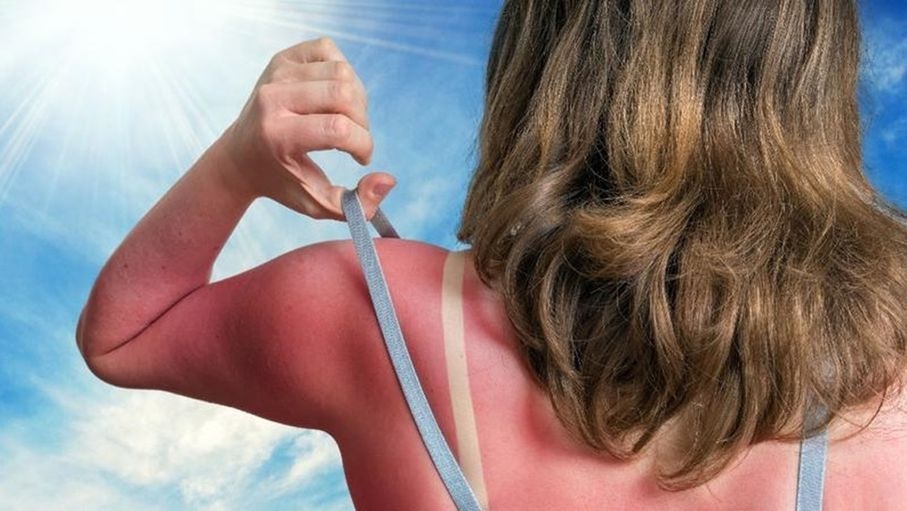 علاجات منزلية مثبتة علميا لحروق الشمس