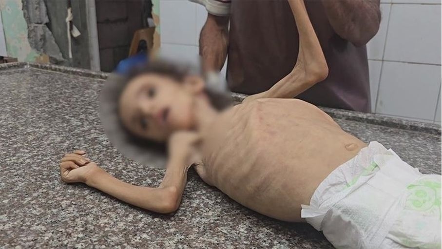 رزان تموت جوعا... طفلة أخرى تُزهَق روحها بسبب تجويع إسرائيل للفلسطينيين بغزة