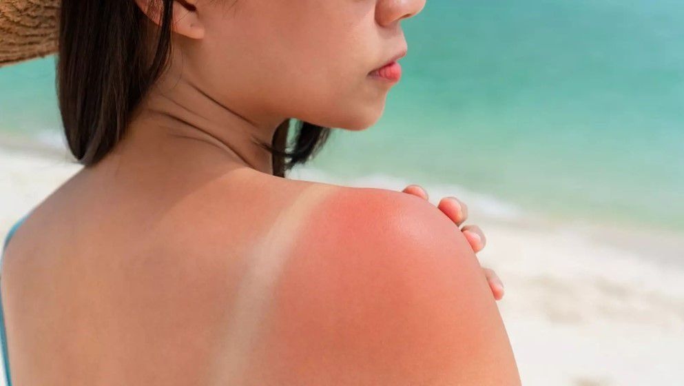 Scientifically Proven Home Remedies for Sunburn - Jordan News