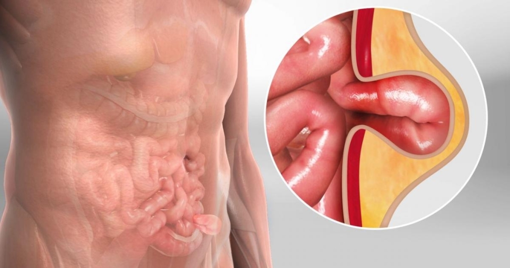 ما هو الفَتق؟ وماهي أعراضه وطرق علاجه؟