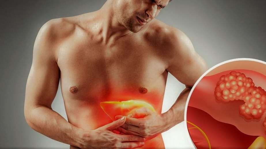 الاكتشاف المبكر والوقاية .. كل ما تريد معرفته عن أمراض الكبد