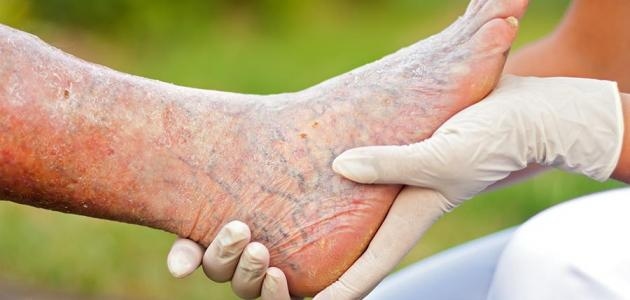 تنبيه.. هؤلاء الأشخاص الأكثر عرضة لدوالى القدمين