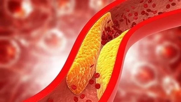 علامات تظهر في اليدين تشير إلى ارتفاع الكوليسترول في الدم