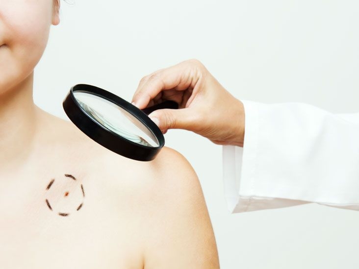 Skin Cancer Symptoms And Images